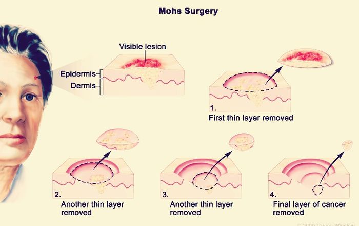 MOHS SURGERY